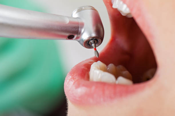 Best Emergency Wisdom Teeth Removal in Staffd, OR
